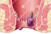 混合痔