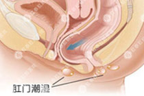 肛门湿疹