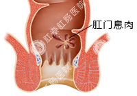 肛门息肉百科