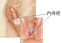 福州内痔百科