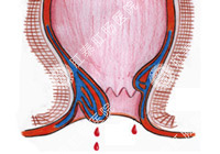 便血百科，便血怎么治？