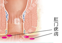肛门疣病百科