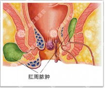 肛周脓肿要手术治疗原因