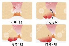 福州内痔有哪些症状表现