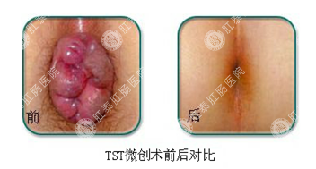 福州内痔有哪些症状表现