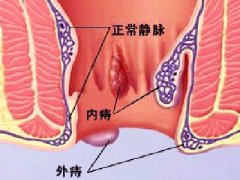 痔疮的典型症状都有什么