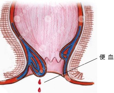 痔疮便血