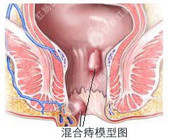 混合痔手术治疗好吗