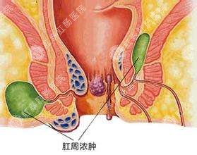 福州治疗痔疮的好医院