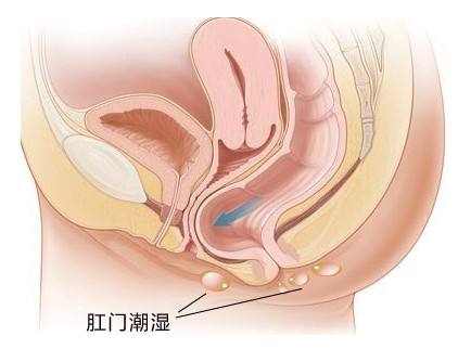 福州肛门湿疹怎么治疗