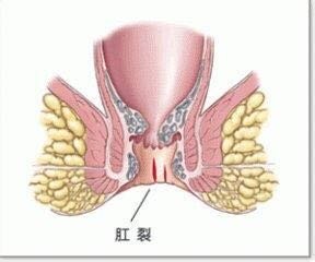 福州治疗肛裂费用多钱