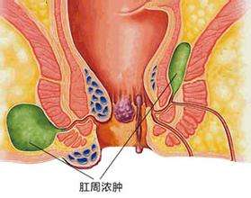 福州肛周脓肿的好医院