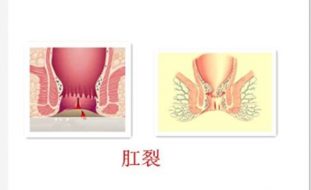 肛裂该怎么治疗好