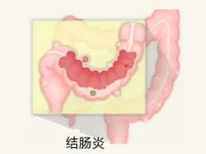 福州哪家医院治疗结肠炎好